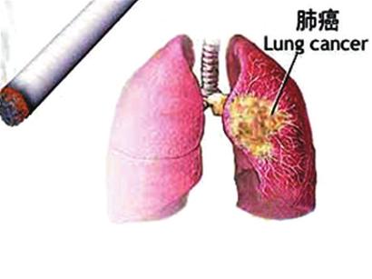 胸部CT低剂量筛查早期肺癌